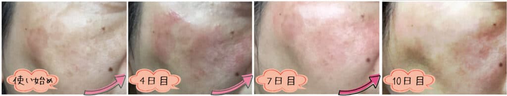 日本人が使用したトレチノイン